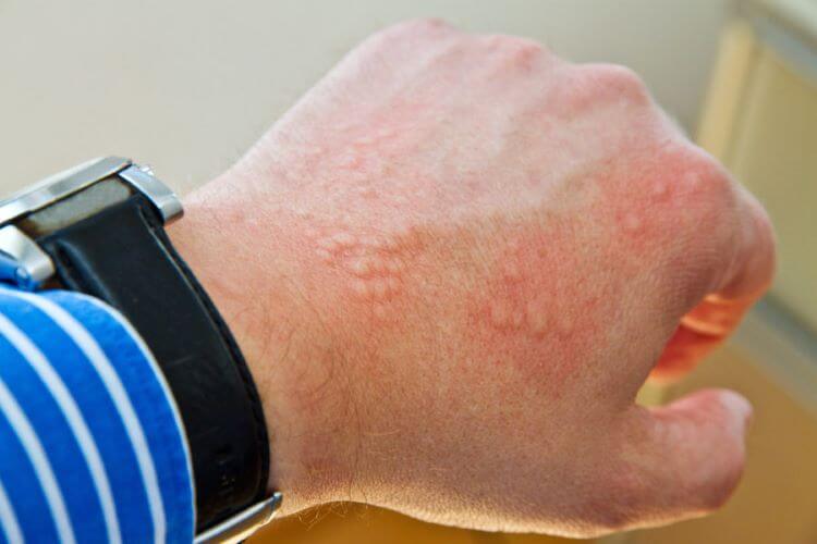 درماتیت تماسی، یکی از انواع حساسیت پوست دست