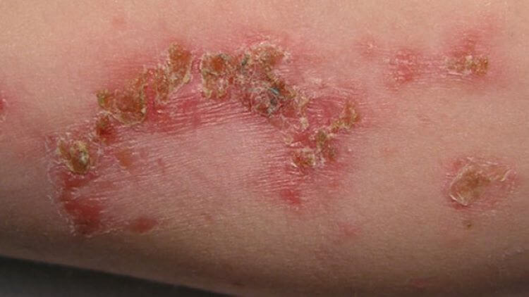 علائم عفونت پوستی چیست